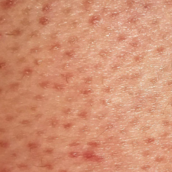 Strawberry Legs : Comment En Venir à Bout ?