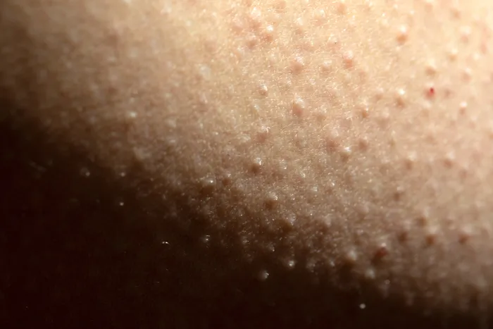 Kératose pilaire et intolérance au gluten : un lien physiologique souvent sous-estimé